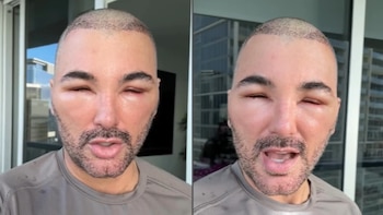 Famoso ex actor de telenovelas en Televisa alarma a fans tras reaparecer con el rostro ‘desfigurado’; esto le pasó
(Fotos: Instagram/@mauriciomejia)