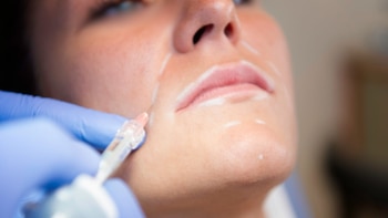 El tratamiento coreano utiliza microneedling